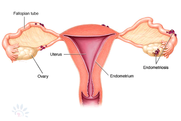 Akshaya Endometriosis