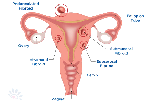 Akshaya Endometriosis