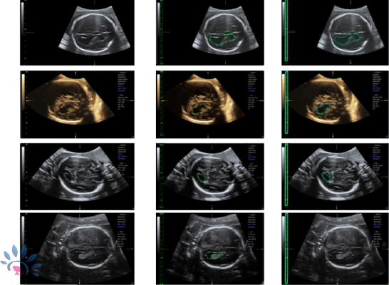 Akshaya Fetal Neurosonogram