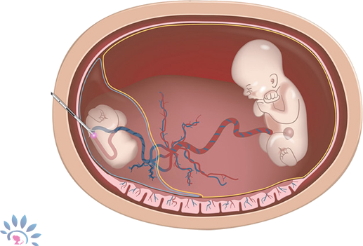 Akshaya Fetal Neurosonogram