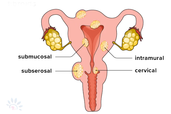 Akshaya Fibroids Details