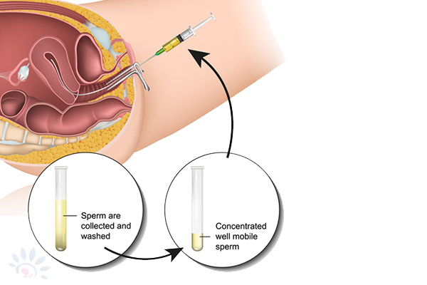 Akshaya Intrauterine Insemination (IUI)