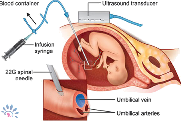 Akshaya IntrauterineTransfusion