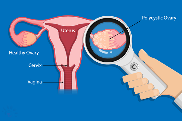 Akshaya PCOS