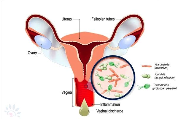 Akshaya Gynecology Issues Vaginitis